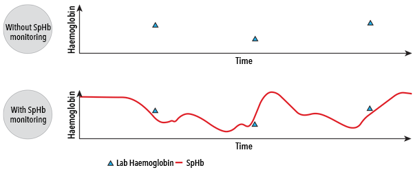 Masimo - SpHb - Value of SpHb Monitoring Graph